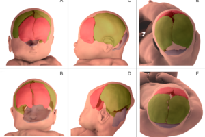 La déformation du crâne du nourrisson observée lors de l’accouchement