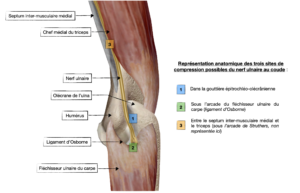 Représentation anatomique des trois zones de compressions du nerf ulnaire au coude par Florian Gaubert, ostéopathe à Uchaud dans le Gard