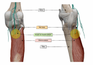 Localisation de la compression du nerf tibial sous l’arcade du muscle soléaire dans le syndrome de compression du nerf tibial par Florian Gaubert, ostéopathe à Uchaud dans le Gard